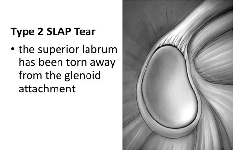 type 2 slap tear surgery.